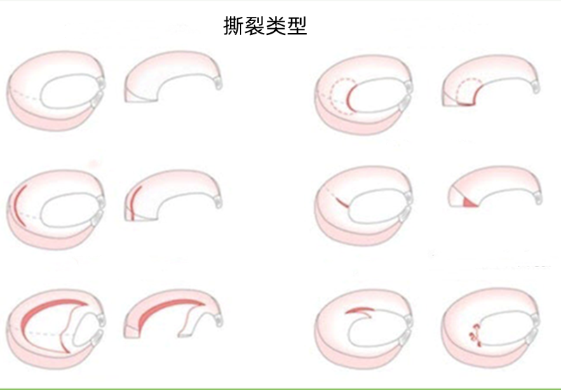 半月板破裂不手术能恢复吗（半月板撕裂，多久能痊愈？）